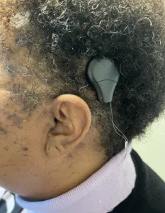 Side view of head with hearing device